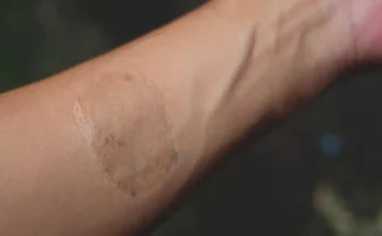 An oval-shaped scar on a woman's hand | Source: Shutterstock