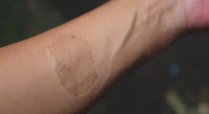 An oval-shaped scar on a woman's hand | Source: Shutterstock